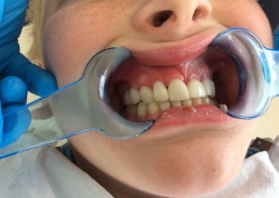 Development Anomalies After Treatment