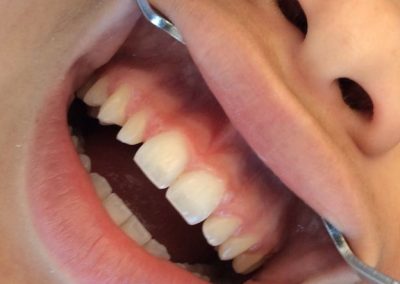 Before Laser and composite to create normal size lateral incisors