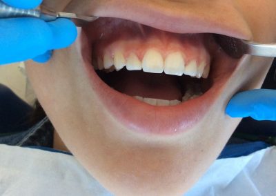 After Laser and composite to create normal size lateral incisors