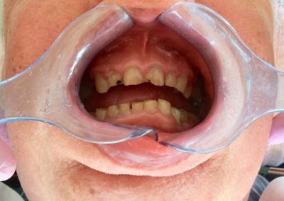 Prosthodontic Before