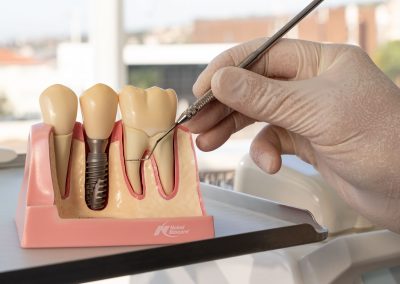 Endodontic Dentistry Kloof Dentist