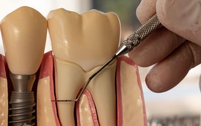 Endodontic Dentistry Kloof Dentist