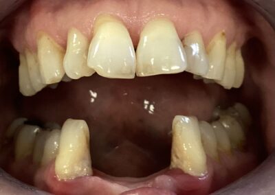 Composite Restoration