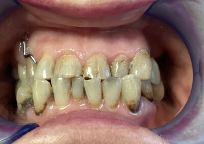 Restoration of the lower teeth