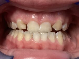 Turning canines into lateral incisors