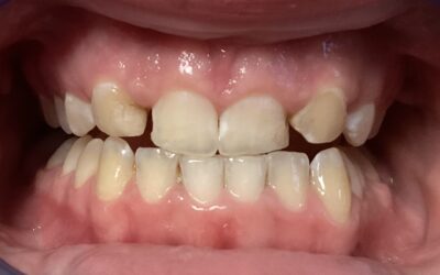 Turning canines into lateral incisors