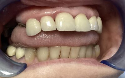 One year follow up of a rehab with gumprofiling